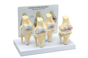4-Stage Osteoarthritis Knee Model
